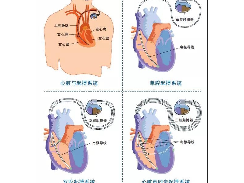 铜川矿务局中心医院开展了首例双腔起搏器-植入型心律转复除颤器植入术