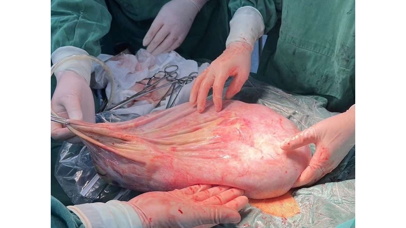 铜川矿务局中心医院成功为一患者实施了巨大罕见卵巢囊肿切除术
